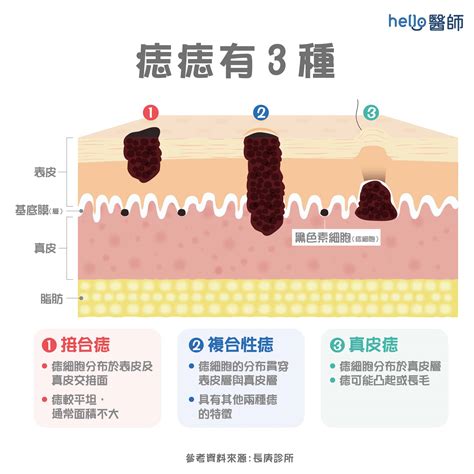 身體有痣|痣形成的原因？痣長毛、痣變多變大是痣病變？5招判別